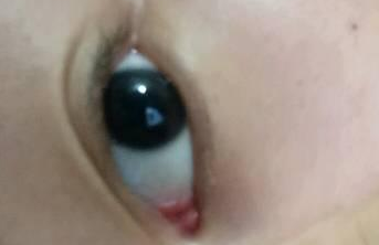 外眼角術(shù)后如何快速消腫？