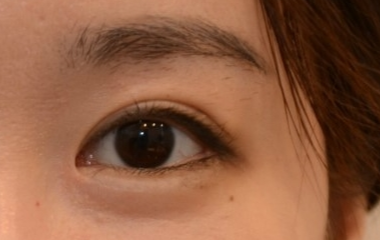 外眼角開大了能修復(fù)嗎？