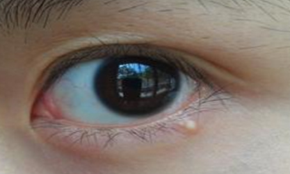 開(kāi)外眼角手術(shù)會(huì)有后遺癥嗎？