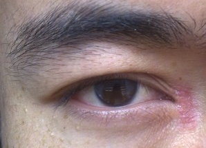 開眼角術(shù)后如何快速消腫？