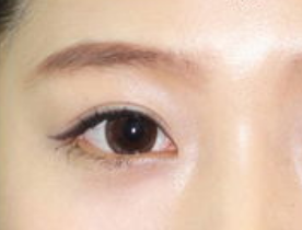 做完開眼角效果好嗎？開眼角術(shù)后注意事項有哪些？