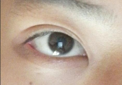 開眼角手術(shù)后會影響視力嗎？