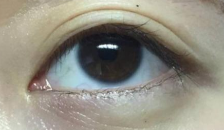 開眼角手術(shù)多長時間恢復(fù)？