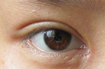 開眼角手術(shù)會不會留疤？開眼角手術(shù)后應(yīng)該注意什么？