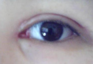 做完雙眼皮開(kāi)內(nèi)眼角有風(fēng)險(xiǎn)嗎？做完開(kāi)眼角怎樣護(hù)理？