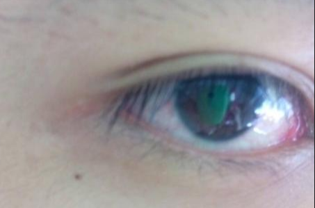 開眼角手術(shù)完全恢復(fù)需要多長時間？術(shù)后如何避免留疤？