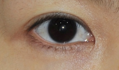 做完開眼角怎樣護(hù)理？