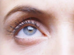 埋線祛眼袋什么時候做好？