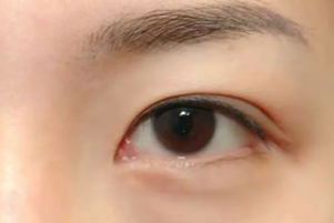 光纖溶脂祛眼袋有效果嗎？光纖溶脂祛眼袋好不好？