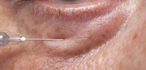 眼袋脂肪釋放的優(yōu)點(diǎn)有哪些？