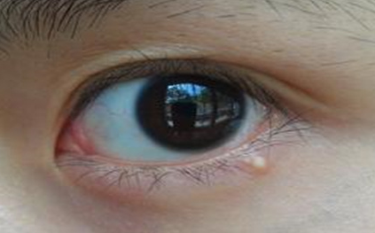 不開刀去眼袋安全嗎？不開刀去眼袋多少錢？