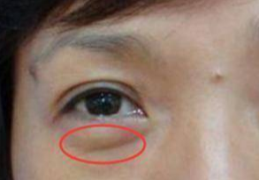 埋線去眼袋能維持多久？