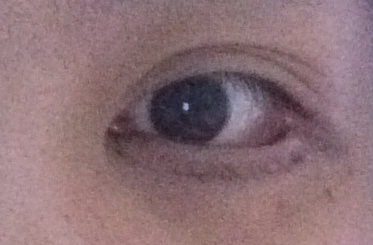 埋線去眼袋有效嗎？