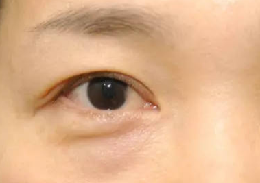 什么是埋線去眼袋？埋線去眼袋能維持多久？