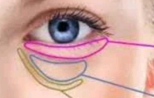 脂肪釋放去眼袋效果怎么樣？