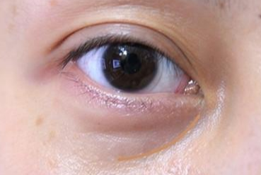 激光祛眼袋是什么原理？激光祛眼袋和內(nèi)切哪個(gè)好？