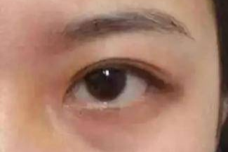 激光祛眼袋有哪些副作用？