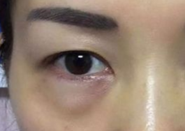 激光可以祛眼袋嗎？激光祛眼袋有哪些副作用？