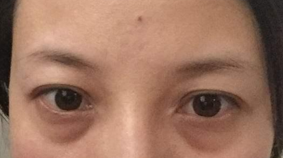 激光祛除眼袋有效嗎？激光祛眼袋有什么利弊？