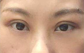 激光祛除眼袋的手術(shù)效果好嗎？