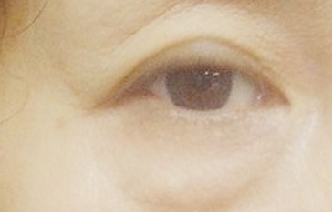 激光祛眼袋能維持多長(zhǎng)時(shí)間？