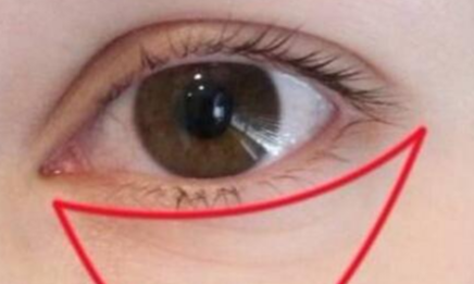 激光祛眼袋有什么利弊？