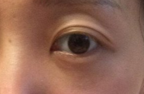 激光去眼袋要注意什么？