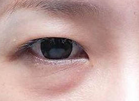 激光去眼袋的方法效果好嗎？激光去眼袋有什么壞處？