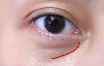 激光去眼袋手術(shù)費用是多少？