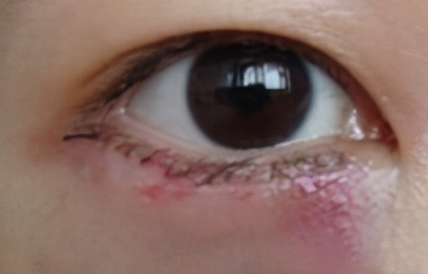 激光去眼袋會不會留疤？