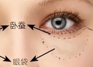 激光去眼袋多久才能恢復(fù)？激光去眼袋有什么副作用嗎？