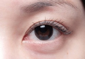 激光去眼袋會不會很疼？