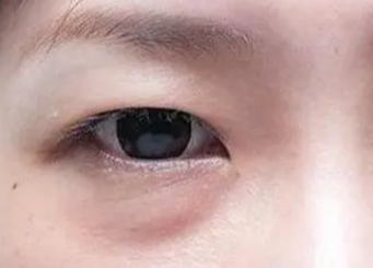 激光去眼袋要多長時(shí)間？做激光去眼袋手術(shù)要多久？