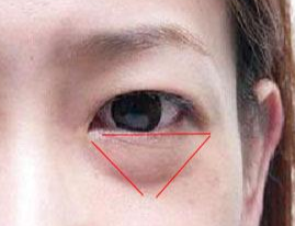 激光除眼袋效果如何？激光去眼袋要注意什么？