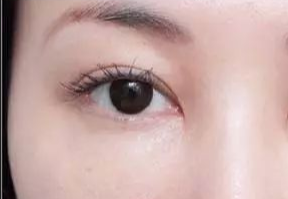 激光去眼袋什么人適合？