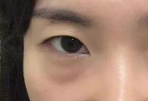 激光祛眼袋會(huì)疼嗎？