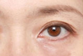 激光去眼袋幾天能恢復(fù)？激光去眼袋是怎樣的？