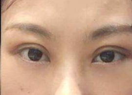 激光去眼袋可保持多久？激光去除眼袋效果好不好？