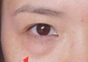 激光去眼袋的效果怎么樣？激光去眼袋注意事項(xiàng)有哪些？