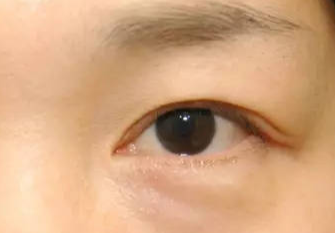 激光去眼袋術(shù)后會(huì)不會(huì)反彈？激光去眼袋術(shù)后注意事項(xiàng)？