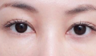 激光去眼袋術后注意事項有哪些？