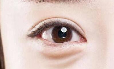 激光去眼袋是永久的嗎？激光去眼袋多少錢？
