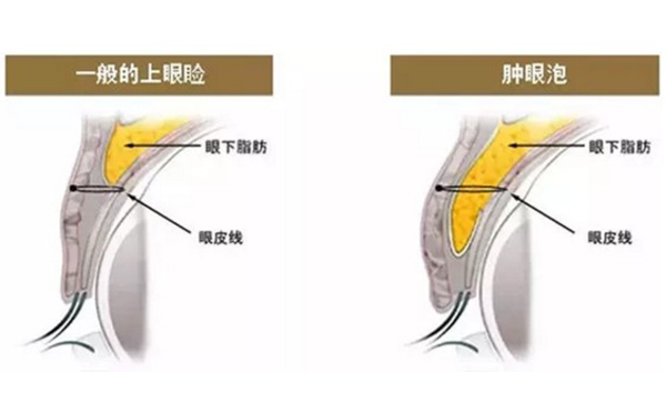割雙眼皮能改善腫眼泡嗎?效果怎么樣?