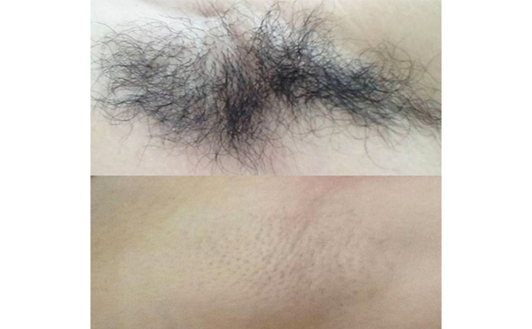 激光脫腋毛疼嗎？