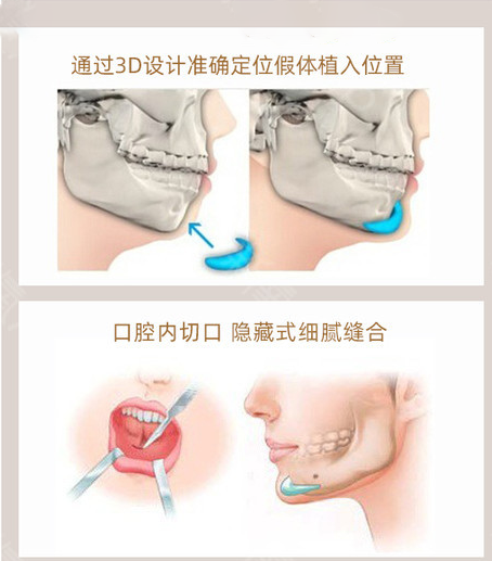 北京潤(rùn)美玉之光醫(yī)療美容墊下巴示意圖
