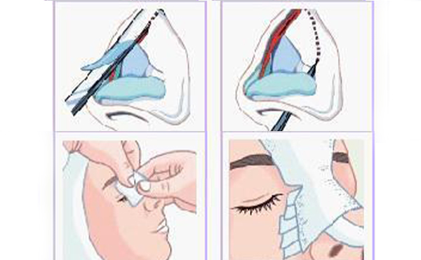 鼻小柱延長手術(shù)材料有哪些？這些材料有什么優(yōu)勢