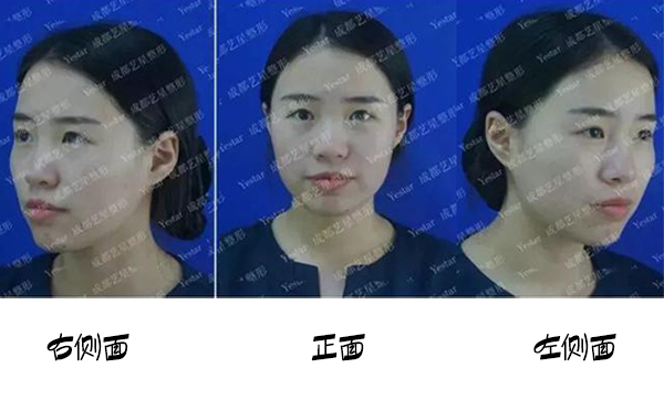 福州名韓整形改善蒜頭鼻大概要花多少錢？