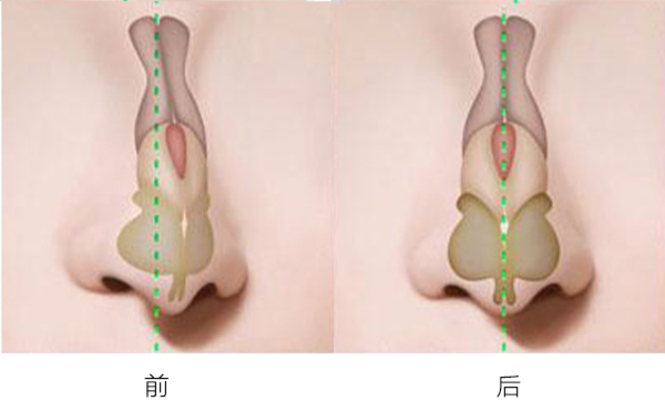 歪鼻整形可以改善什么類型的歪鼻?哪些情況下不允許做歪鼻矯正?