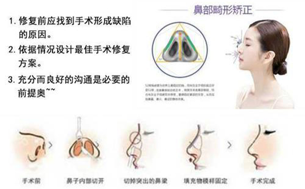 隆鼻修復(fù)效果怎么樣？