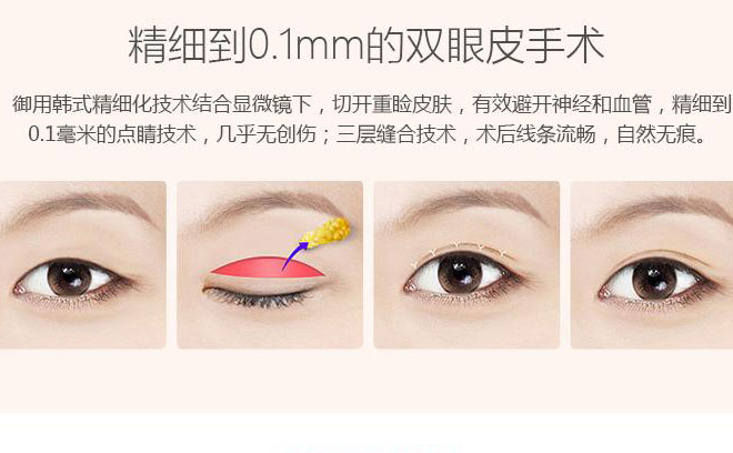 韓式三點(diǎn)雙眼皮一般要多少錢(qián)？